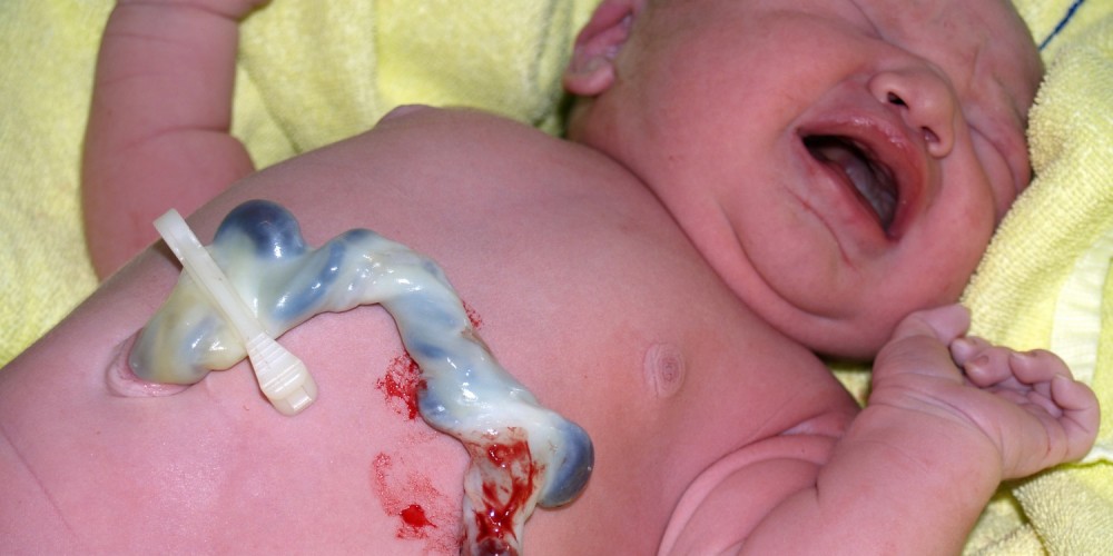 Säugling mit Nabelschnur