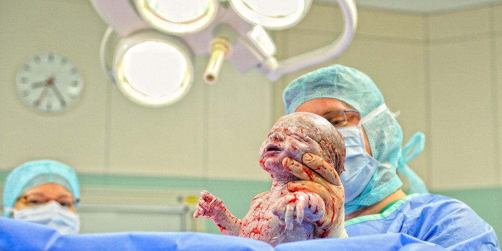 Geburt - Arzt bringt Baby auf die Welt, Neugeborenes kurz vor dem ersten Schrei